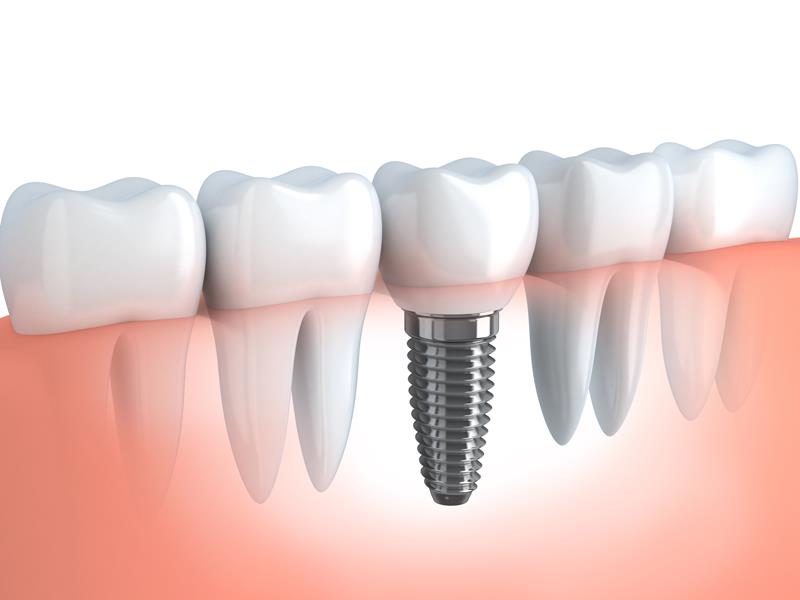 Dental Implants  Hickory, NC 